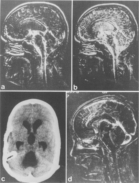 Archival scientific images of the brain used in research on cerebrospinal fluid flow dynamics.